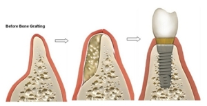 chọn lựa trồng răng implant khi mất một răng