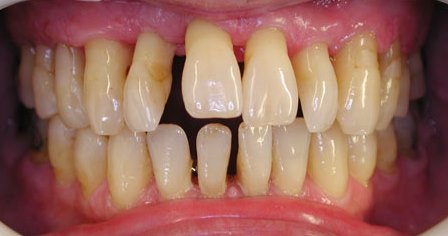 Mất răng do nha chu có cấy ghép implant được không?
