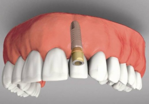 Những giải pháp phục hình khi mất nhiều răng