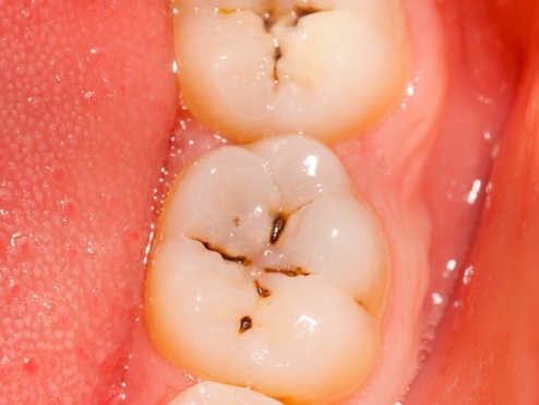 Những lợi ích bọc răng sứ khi răng bị sâu